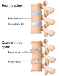 Neck Degenerative Disease-Osteoarthritis