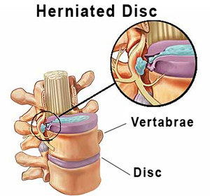 herniated discs
