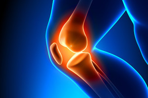 Total Knee Replacement (TKR) or Arthroplasty (TKA)