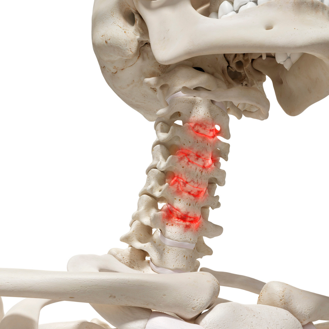 Neck Degenerative Disease/ Osteoarthritis  And Chiropractic Care