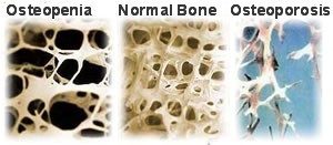 osteoporosis osteopenia